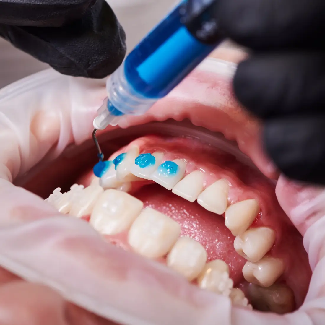 Teeth Whitening Teeth Whitening