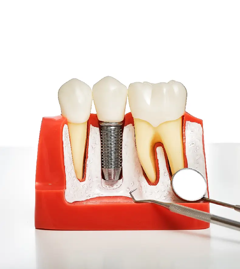 Dental Implant Dental Implant