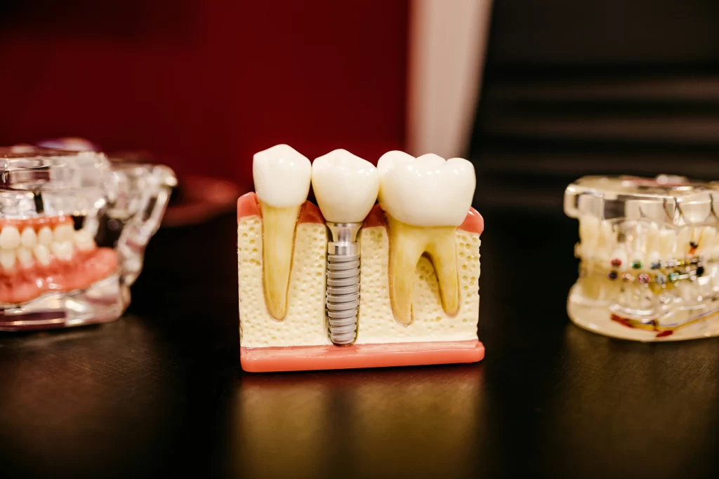 An illustration of dental implants.