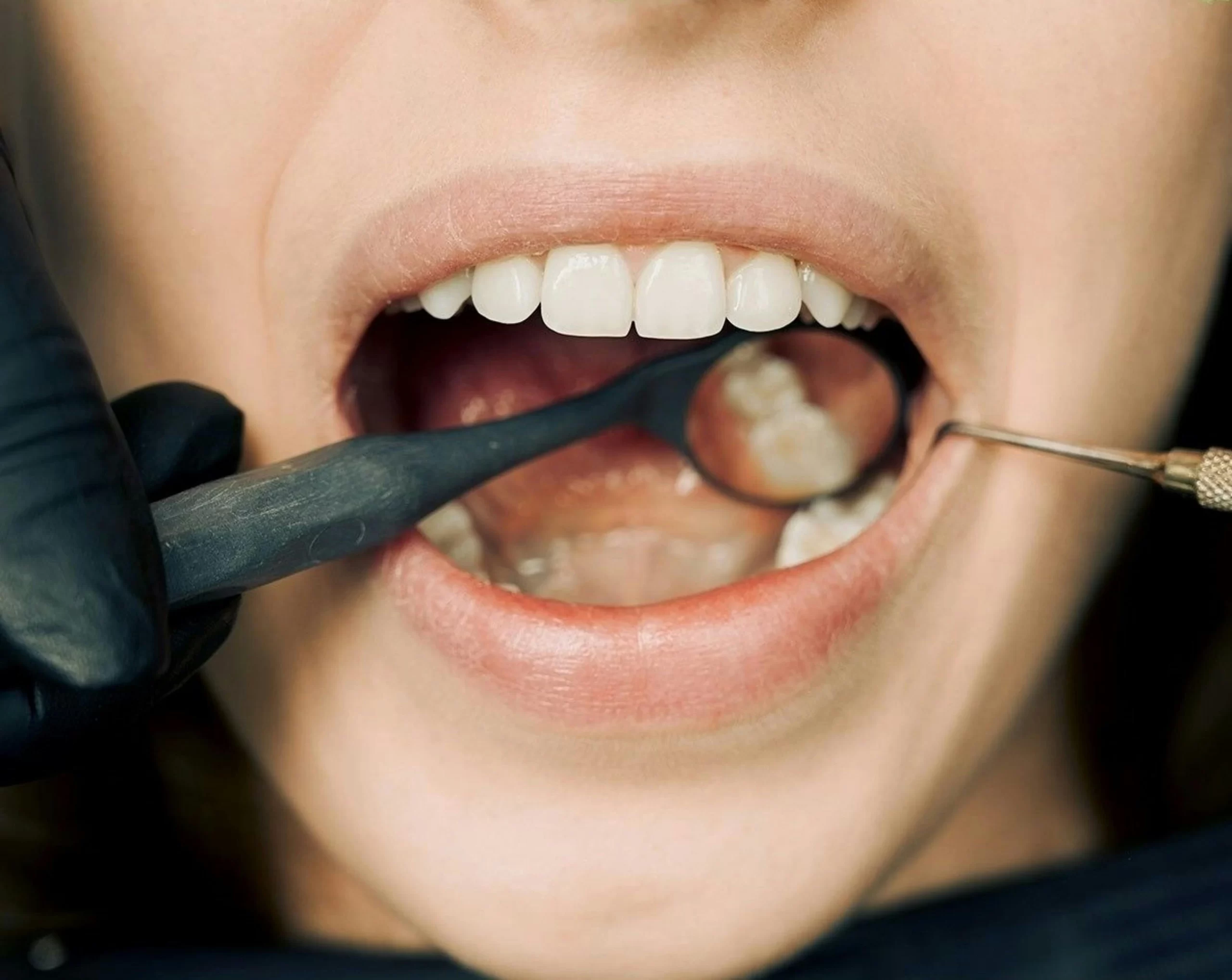 Close-up of a dental check-up showing a dentist examining a patient's teeth using dental tools and a mirror.