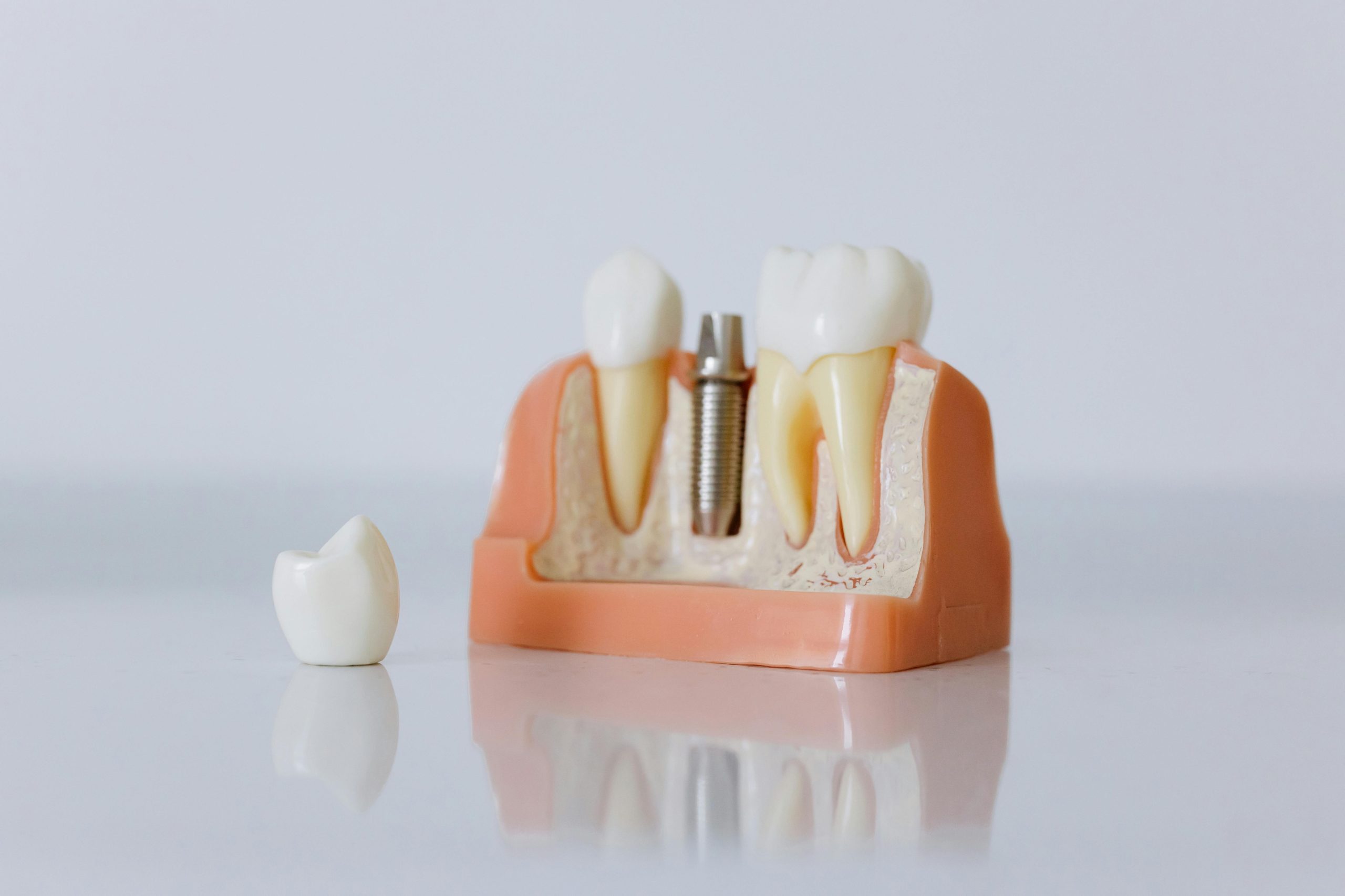 An illustration of a dental implants.