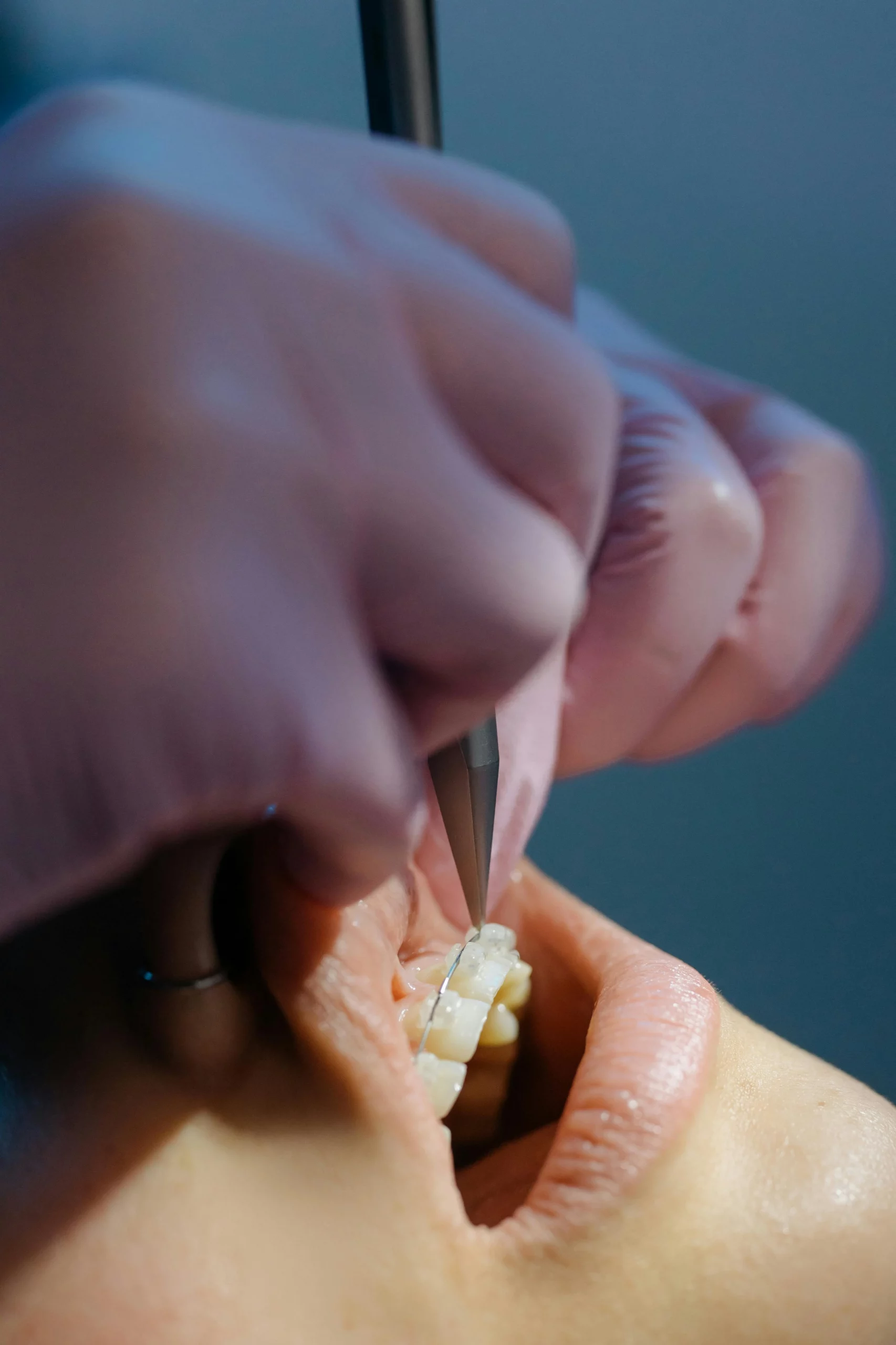 The importance and role of retainers to maintain the dental treatment.