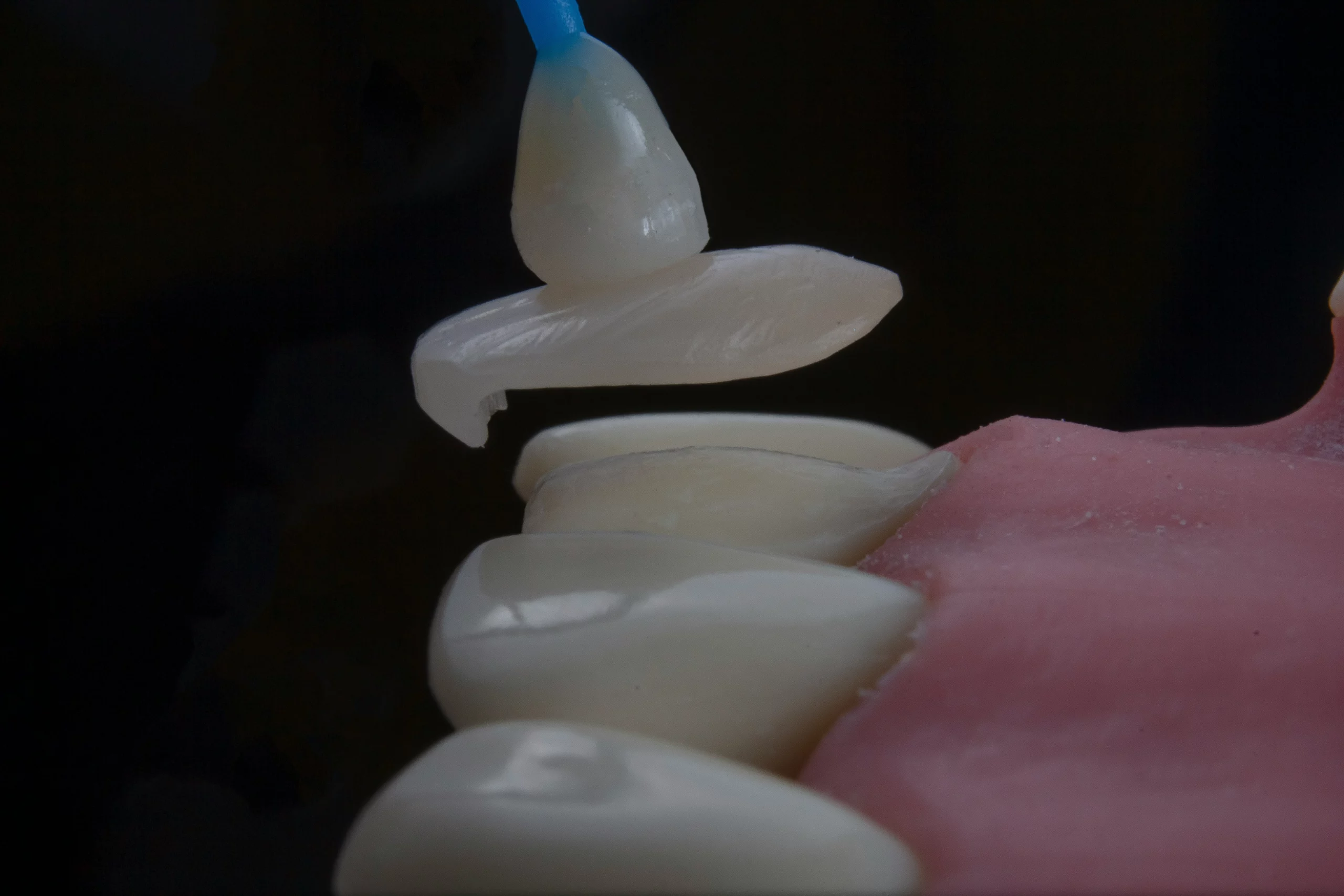How do dental veneers work?
