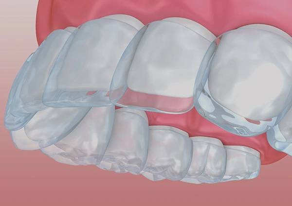 Invisalign for overbites.
