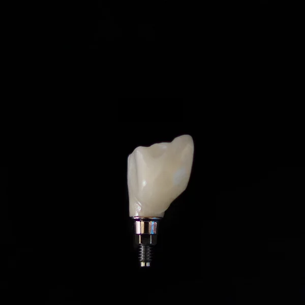 Affordable dental implants.