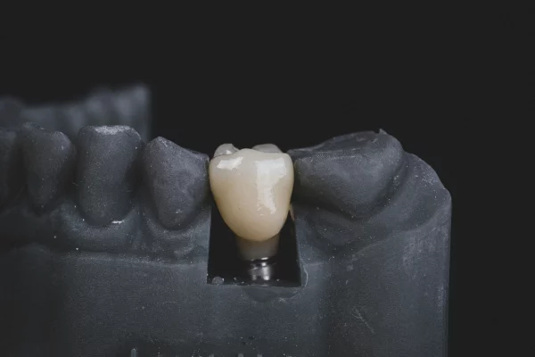Dental implant care.
