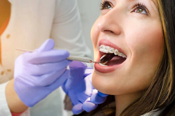 Post-invisalign treatment.