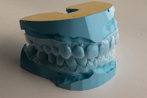 Invisalign before and after: see the result!
