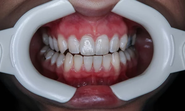 Teeth whitening after braces.
