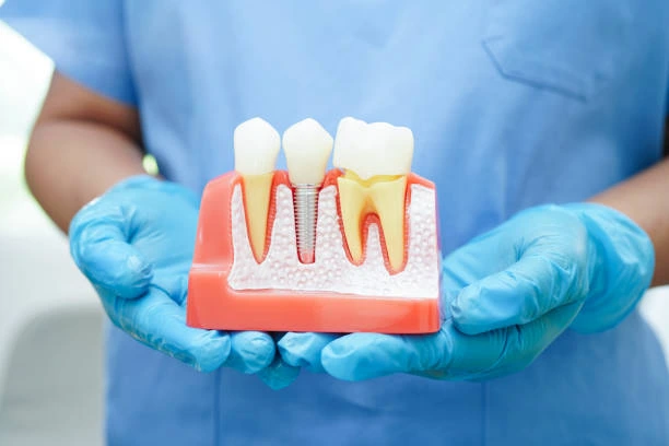 Dental implants warranties.