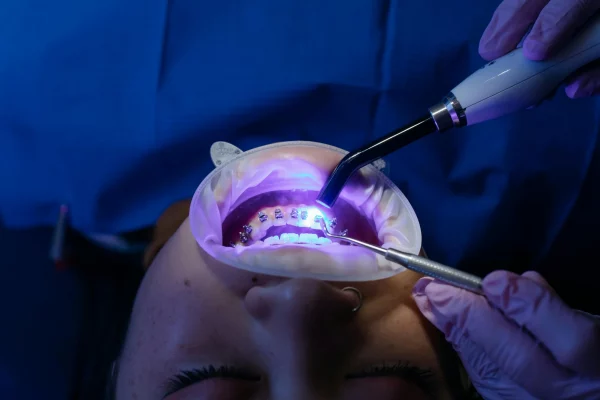 Teeth whitening while on braces.
