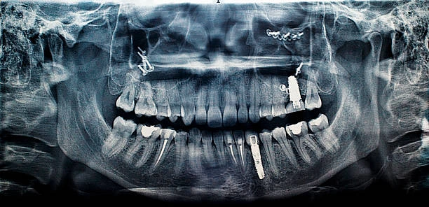 Dental implants vs. Bridges