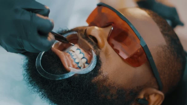 Teeth whitening: is it trend or trouble?